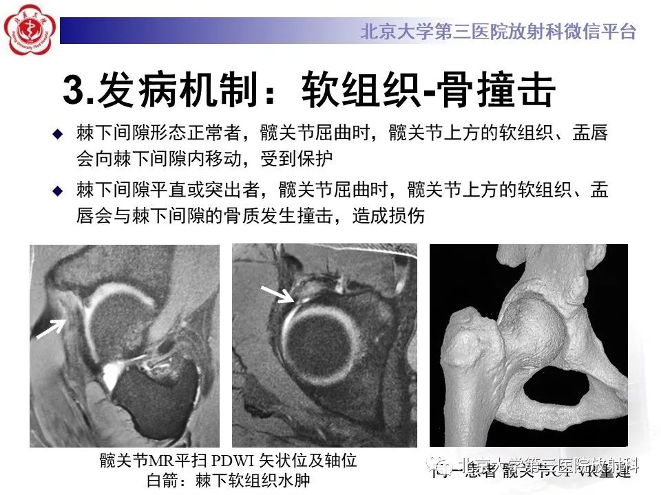 影像PPT - 【PPT】髋关节髂前下棘撞击-20