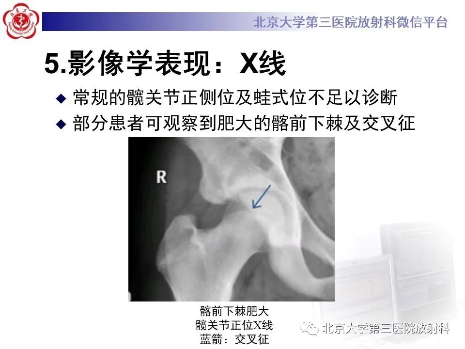 影像PPT - 【PPT】髋关节髂前下棘撞击-22