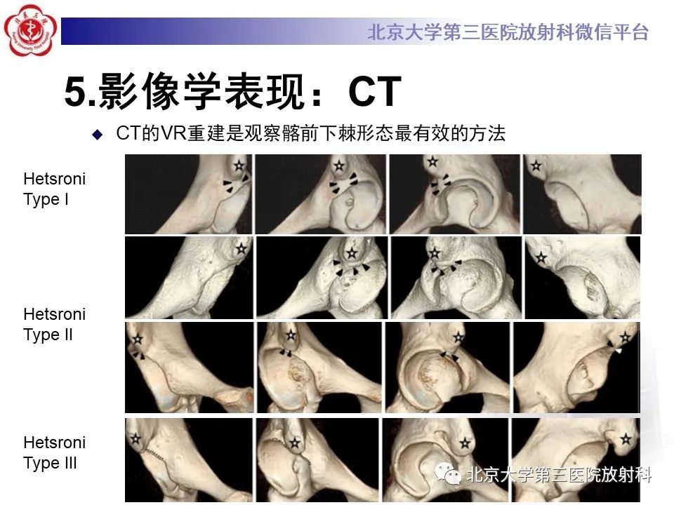 影像PPT - 【PPT】髋关节髂前下棘撞击-24