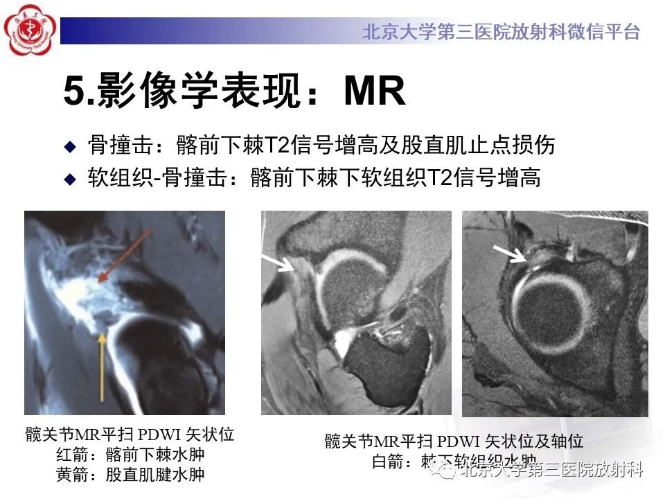 影像PPT - 【PPT】髋关节髂前下棘撞击-25