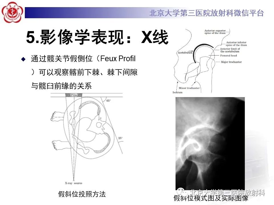 影像PPT - 【PPT】髋关节髂前下棘撞击-23