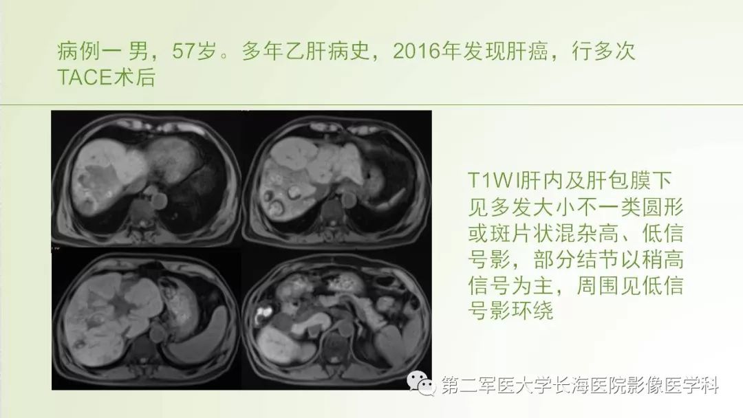 影像PPT - 【PPT】胆汁瘤的影像诊断与临床处理-2