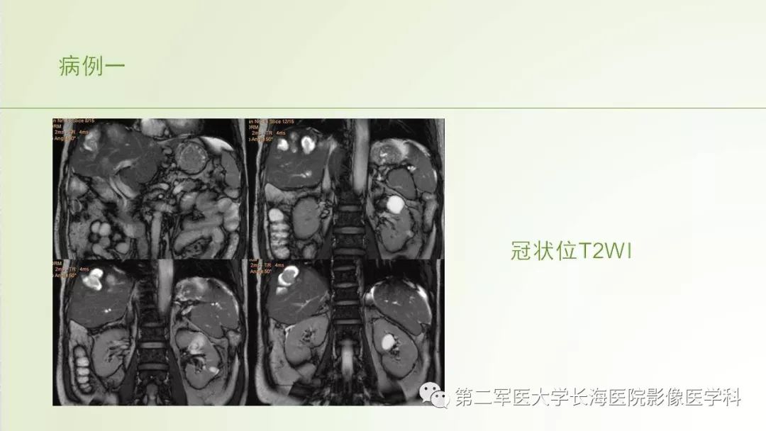 影像PPT - 【PPT】胆汁瘤的影像诊断与临床处理-4