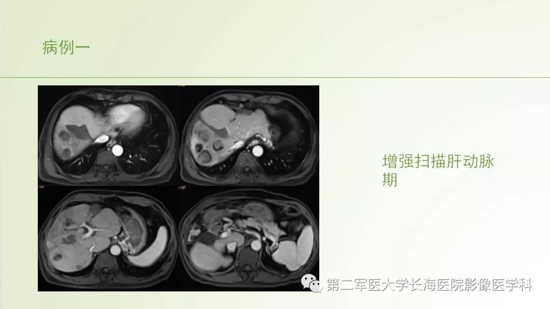 影像PPT - 【PPT】胆汁瘤的影像诊断与临床处理-6