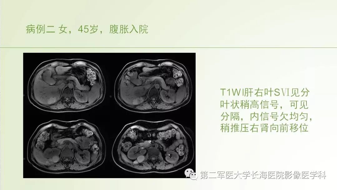 影像PPT - 【PPT】胆汁瘤的影像诊断与临床处理-9
