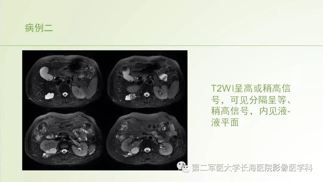 影像PPT - 【PPT】胆汁瘤的影像诊断与临床处理-10