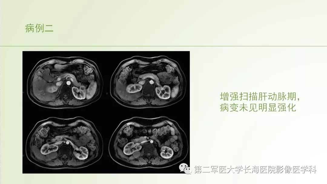 影像PPT - 【PPT】胆汁瘤的影像诊断与临床处理-12