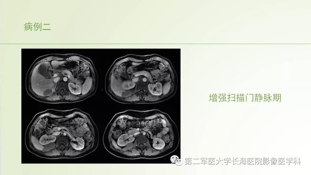 影像PPT - 【PPT】胆汁瘤的影像诊断与临床处理-13