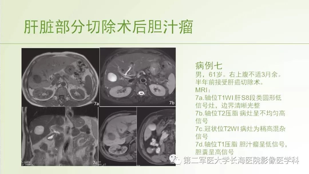 影像PPT - 【PPT】胆汁瘤的影像诊断与临床处理-26