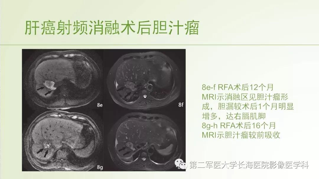影像PPT - 【PPT】胆汁瘤的影像诊断与临床处理-28