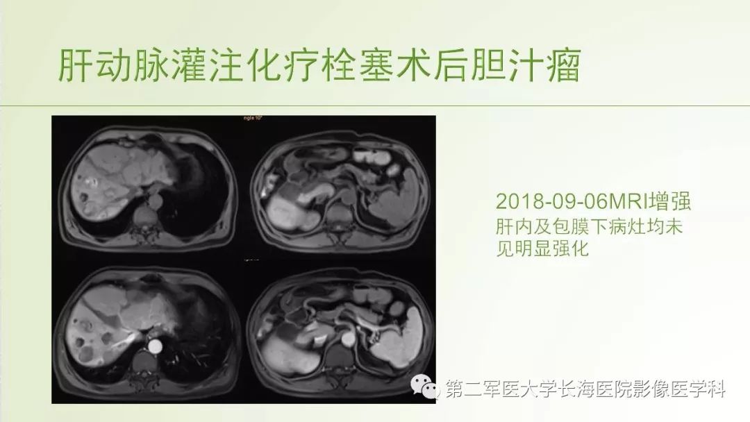 影像PPT - 【PPT】胆汁瘤的影像诊断与临床处理-32