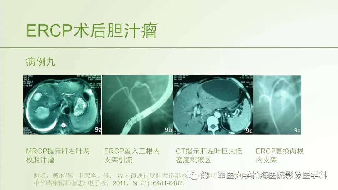 影像PPT - 【PPT】胆汁瘤的影像诊断与临床处理-34