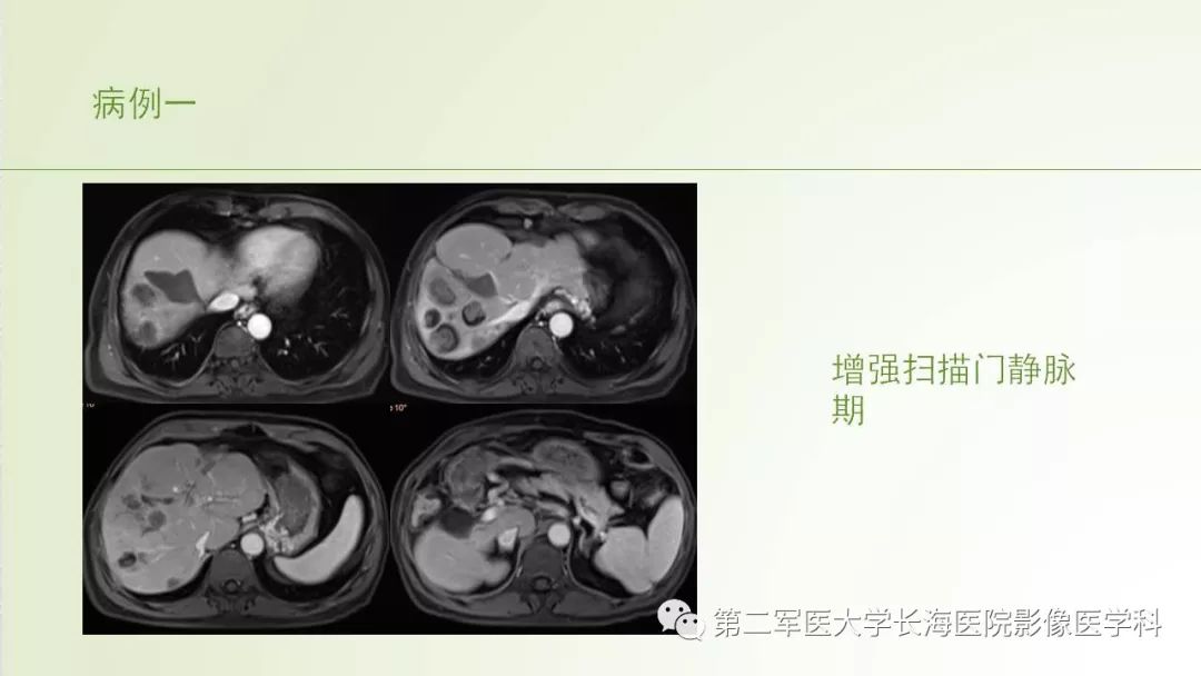 影像PPT - 【PPT】胆汁瘤的影像诊断与临床处理-4