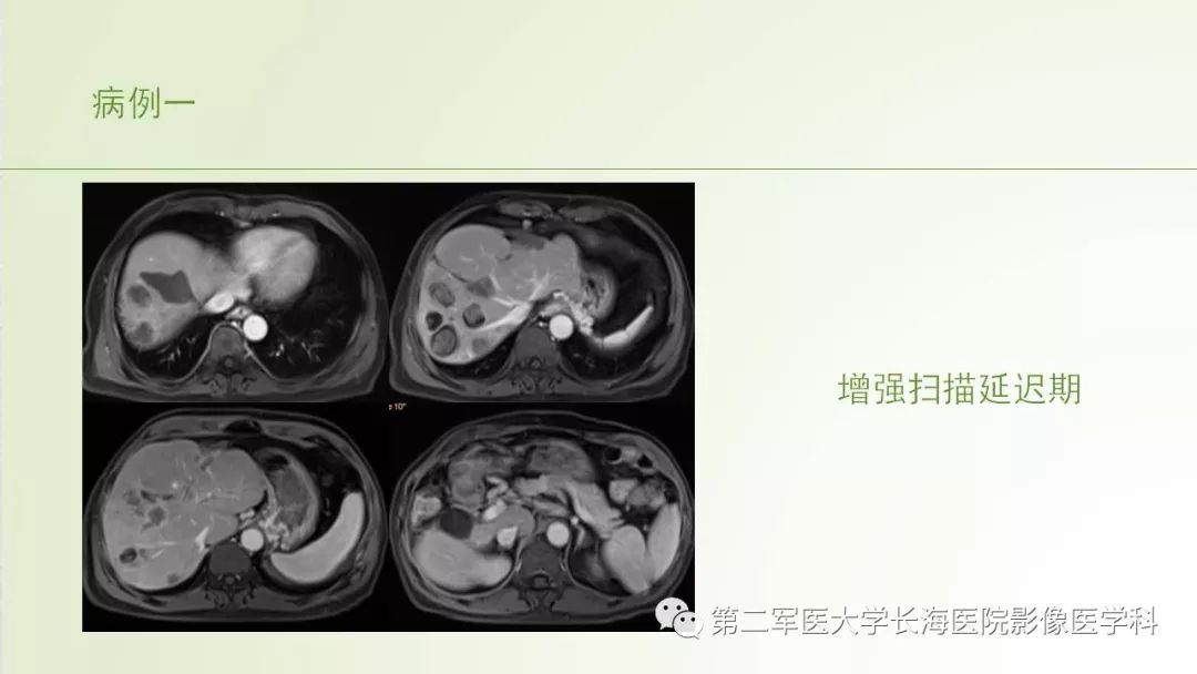 影像PPT - 【PPT】胆汁瘤的影像诊断与临床处理-5
