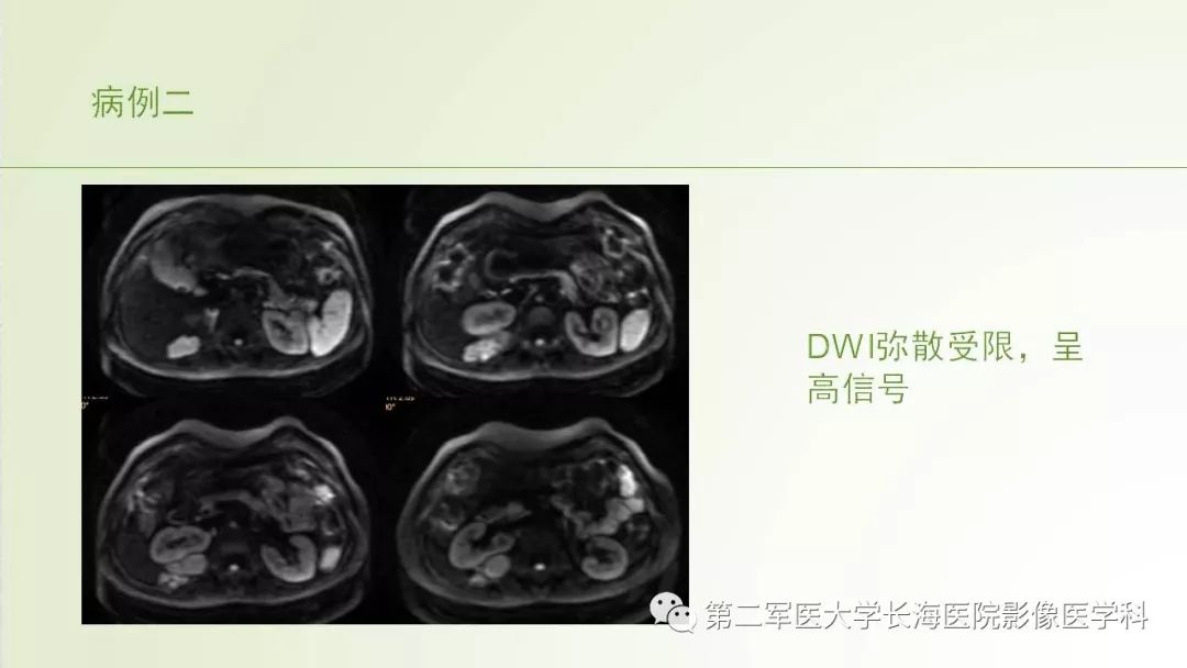 影像PPT - 【PPT】胆汁瘤的影像诊断与临床处理-6