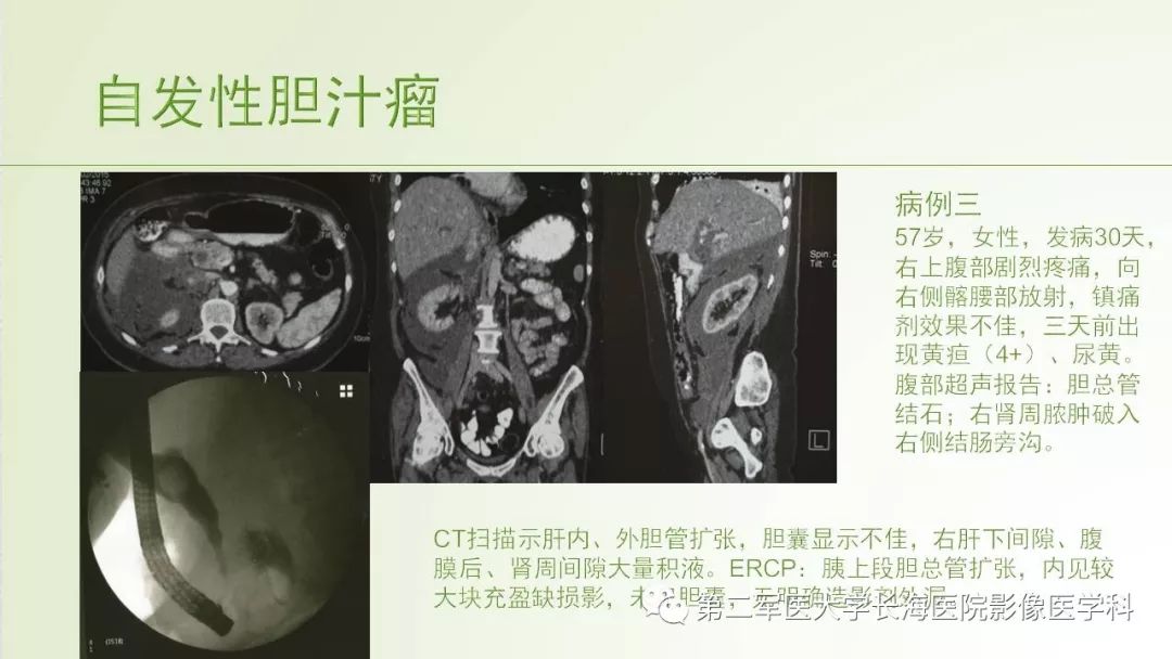 影像PPT - 【PPT】胆汁瘤的影像诊断与临床处理-9