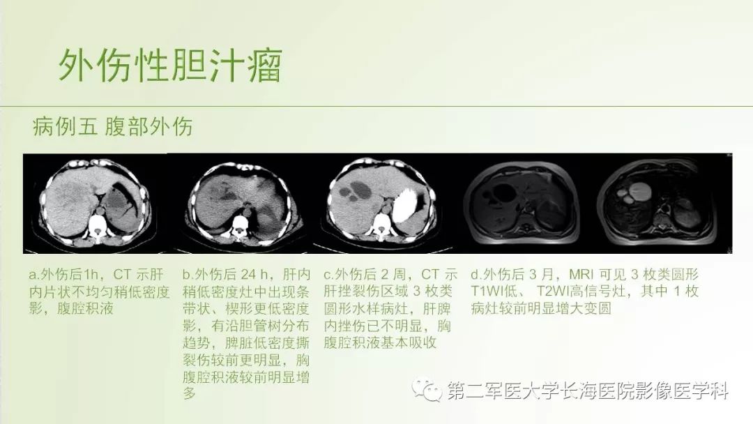 影像PPT - 【PPT】胆汁瘤的影像诊断与临床处理-11