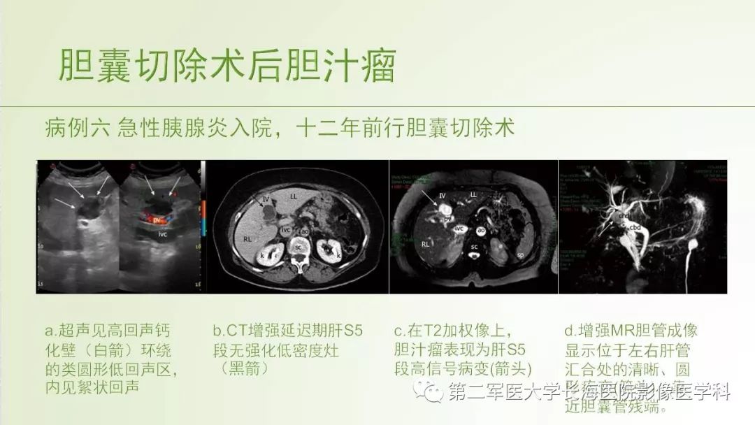 影像PPT - 【PPT】胆汁瘤的影像诊断与临床处理-12