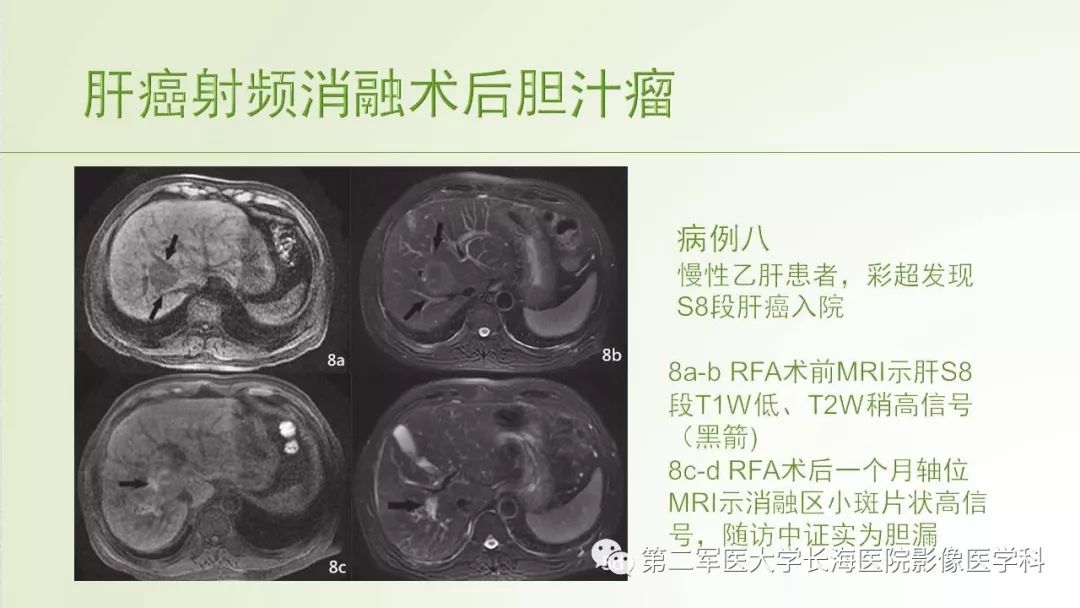 影像PPT - 【PPT】胆汁瘤的影像诊断与临床处理-13