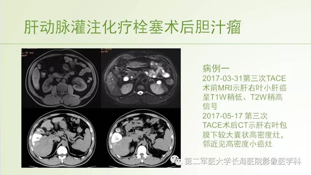 影像PPT - 【PPT】胆汁瘤的影像诊断与临床处理-14