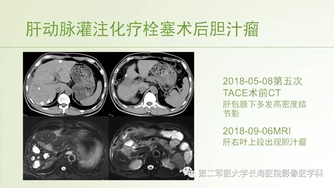 影像PPT - 【PPT】胆汁瘤的影像诊断与临床处理-16
