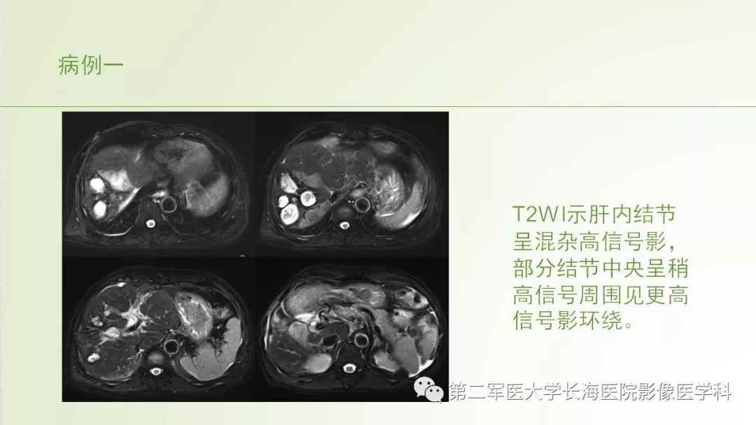 影像PPT - 【PPT】胆汁瘤的影像诊断与临床处理-1