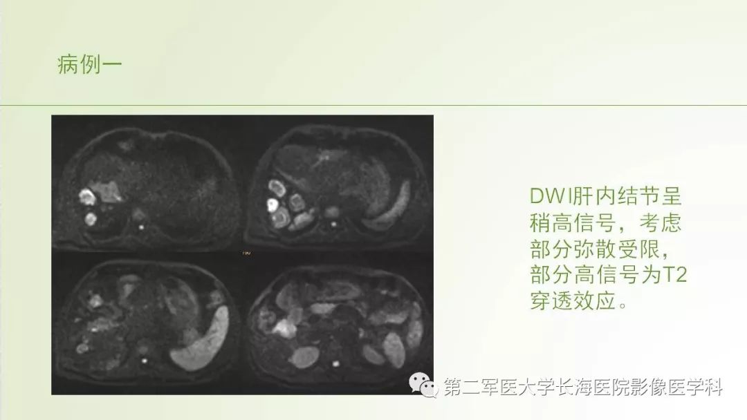 影像PPT - 【PPT】胆汁瘤的影像诊断与临床处理-2