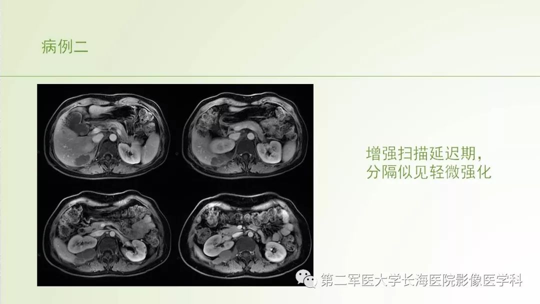 影像PPT - 【PPT】胆汁瘤的影像诊断与临床处理-3