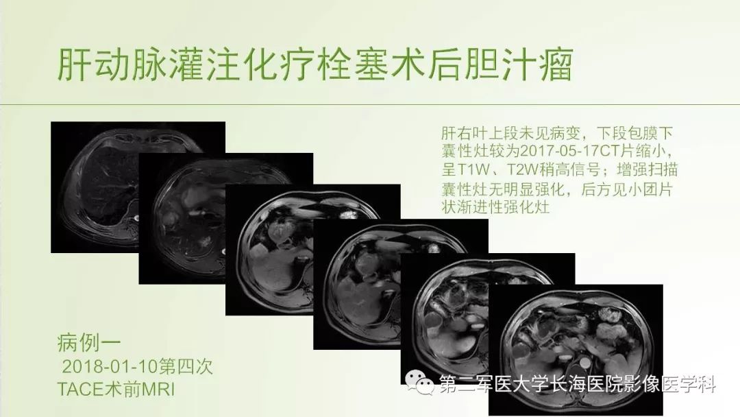 影像PPT - 【PPT】胆汁瘤的影像诊断与临床处理-5