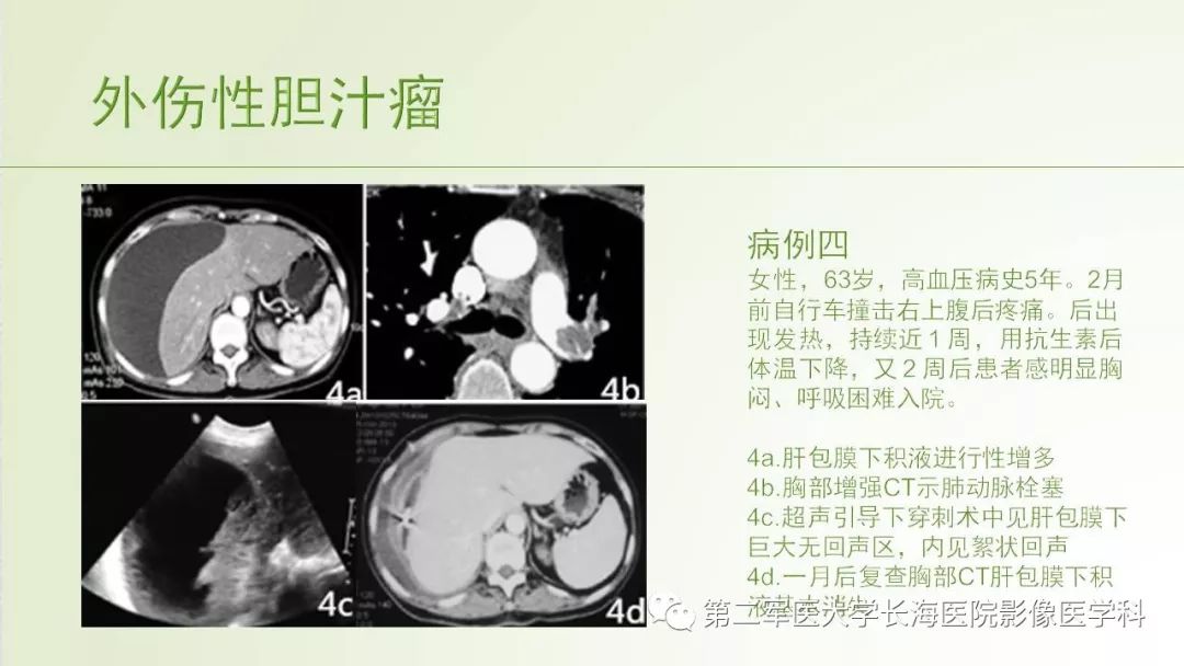 影像PPT - 【PPT】胆汁瘤的影像诊断与临床处理-4