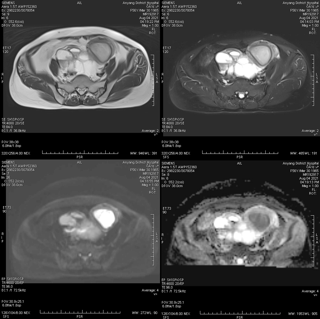 影像PPT - 【病例】子宫内膜浆液性癌1例MR影像-3 影像PPT - 【病例】子宫内膜浆液性癌1例MR影像-3