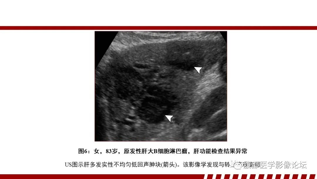 影像PPT - 【PPT】肝脏血液系统疾病影像综述-17