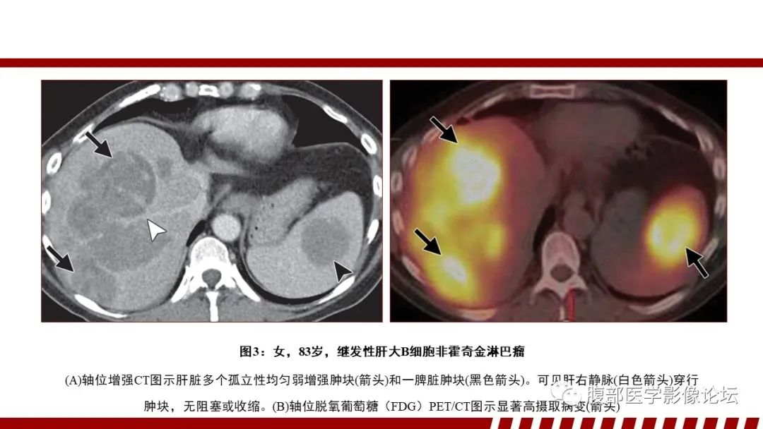 影像PPT - 【PPT】肝脏血液系统疾病影像综述-21