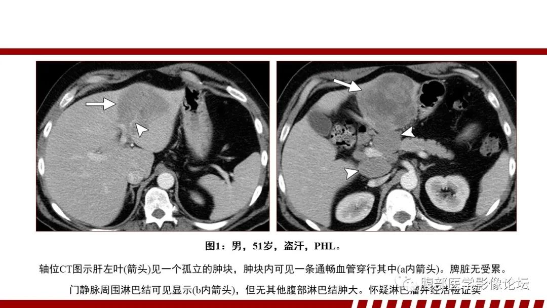 影像PPT - 【PPT】肝脏血液系统疾病影像综述-19