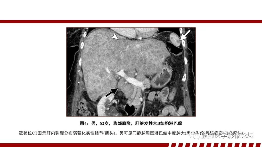 影像PPT - 【PPT】肝脏血液系统疾病影像综述-22