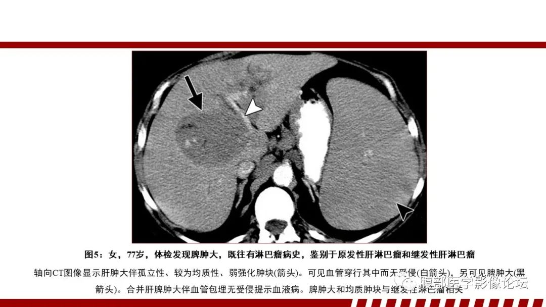 影像PPT - 【PPT】肝脏血液系统疾病影像综述-23