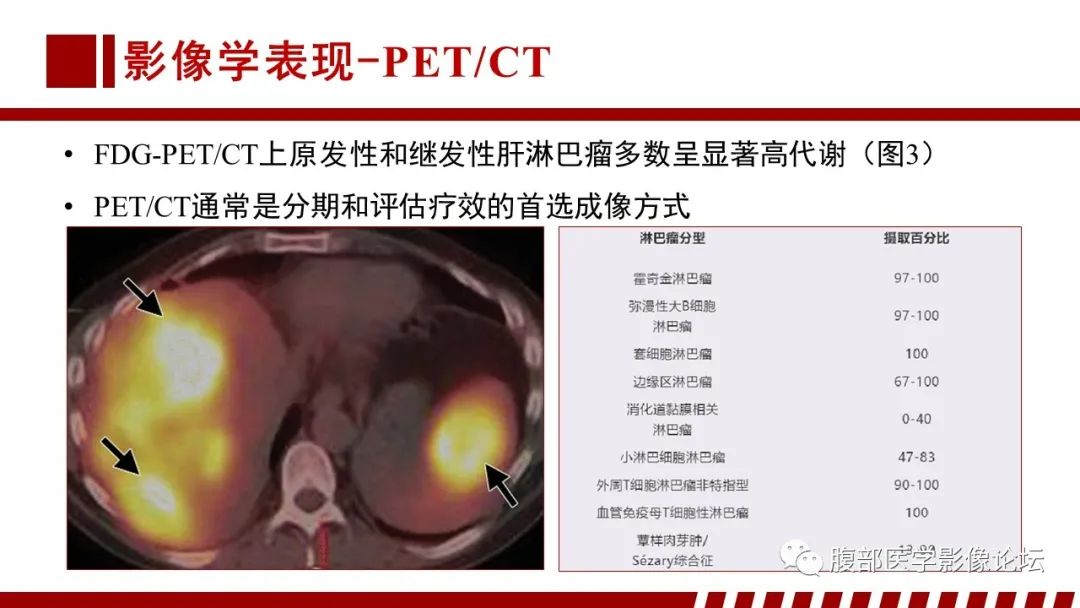影像PPT - 【PPT】肝脏血液系统疾病影像综述-27
