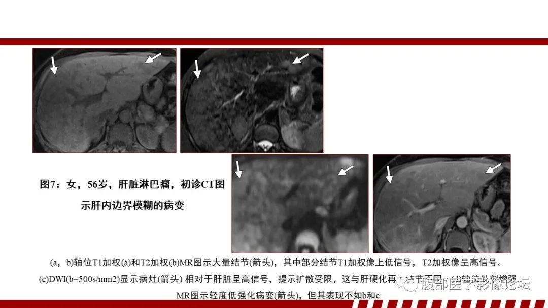 影像PPT - 【PPT】肝脏血液系统疾病影像综述-25