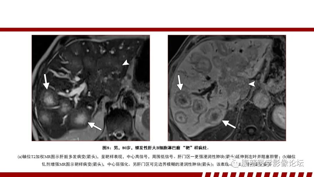 影像PPT - 【PPT】肝脏血液系统疾病影像综述-26