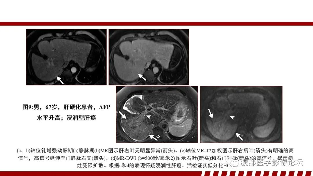 影像PPT - 【PPT】肝脏血液系统疾病影像综述-30