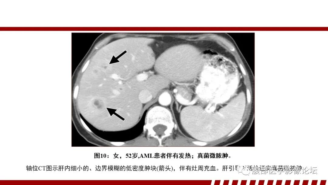 影像PPT - 【PPT】肝脏血液系统疾病影像综述-32