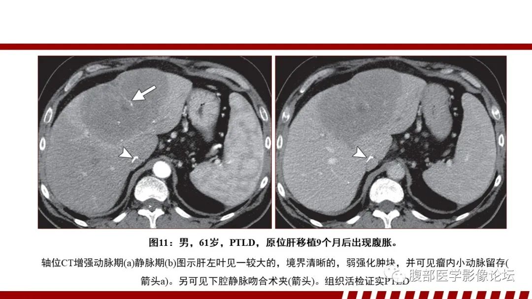 影像PPT - 【PPT】肝脏血液系统疾病影像综述-42