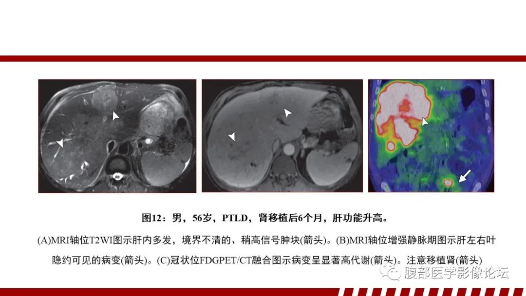 影像PPT - 【PPT】肝脏血液系统疾病影像综述-44