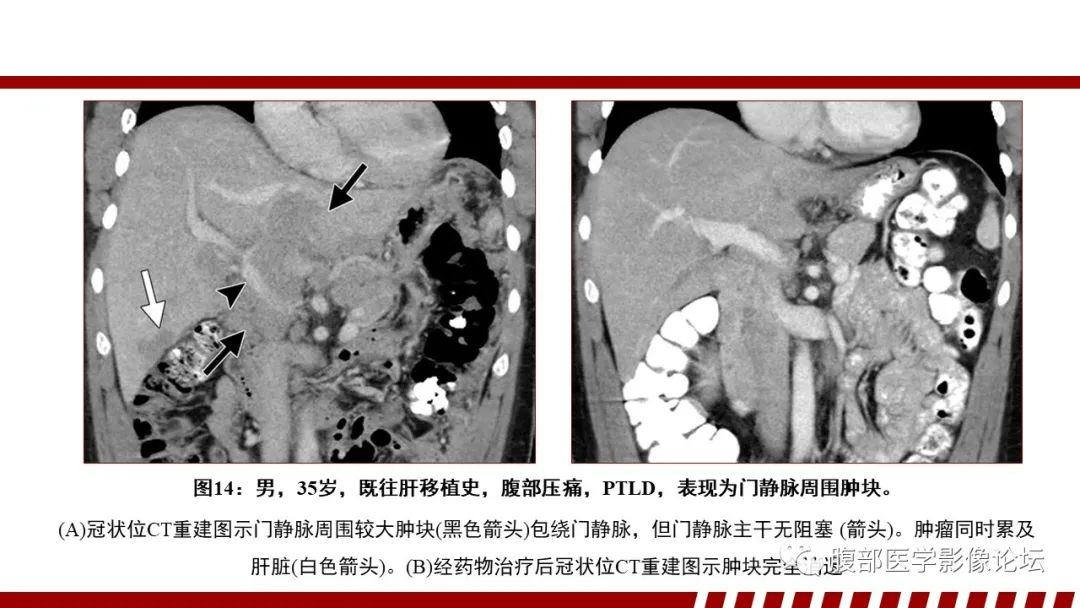 影像PPT - 【PPT】肝脏血液系统疾病影像综述-46