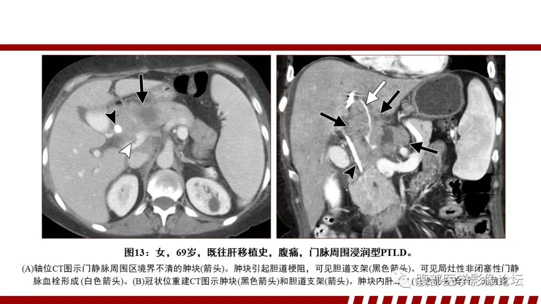影像PPT - 【PPT】肝脏血液系统疾病影像综述-45