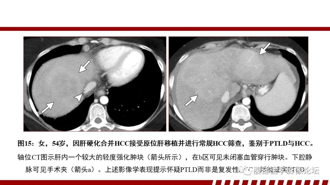 影像PPT - 【PPT】肝脏血液系统疾病影像综述-48