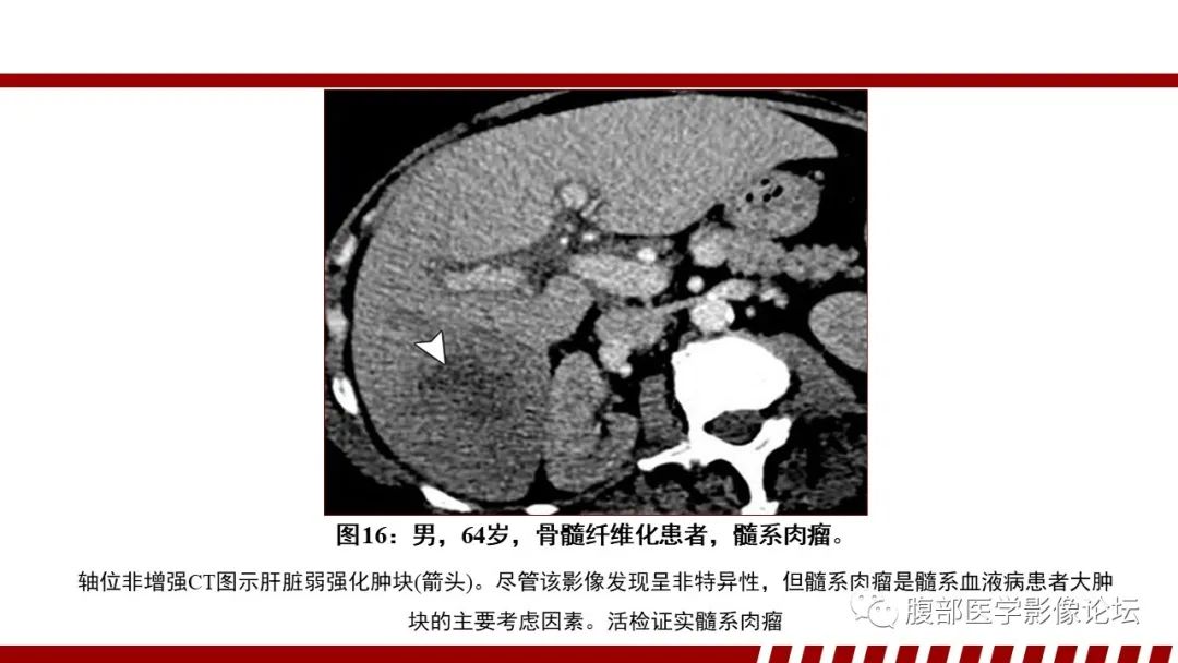 影像PPT - 【PPT】肝脏血液系统疾病影像综述-58