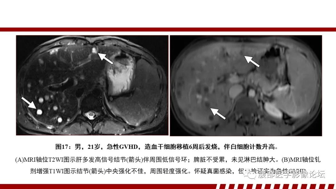影像PPT - 【PPT】肝脏血液系统疾病影像综述-62