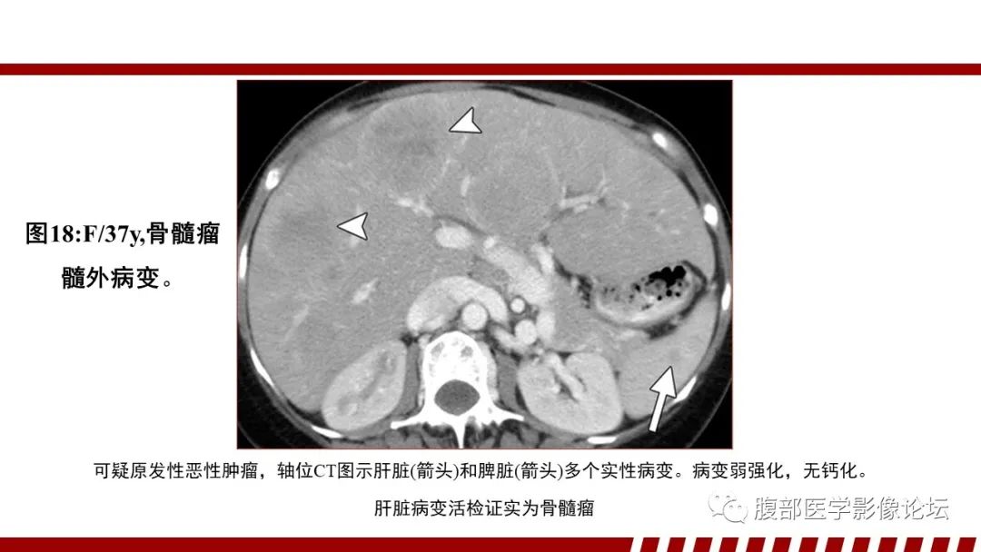 影像PPT - 【PPT】肝脏血液系统疾病影像综述-74