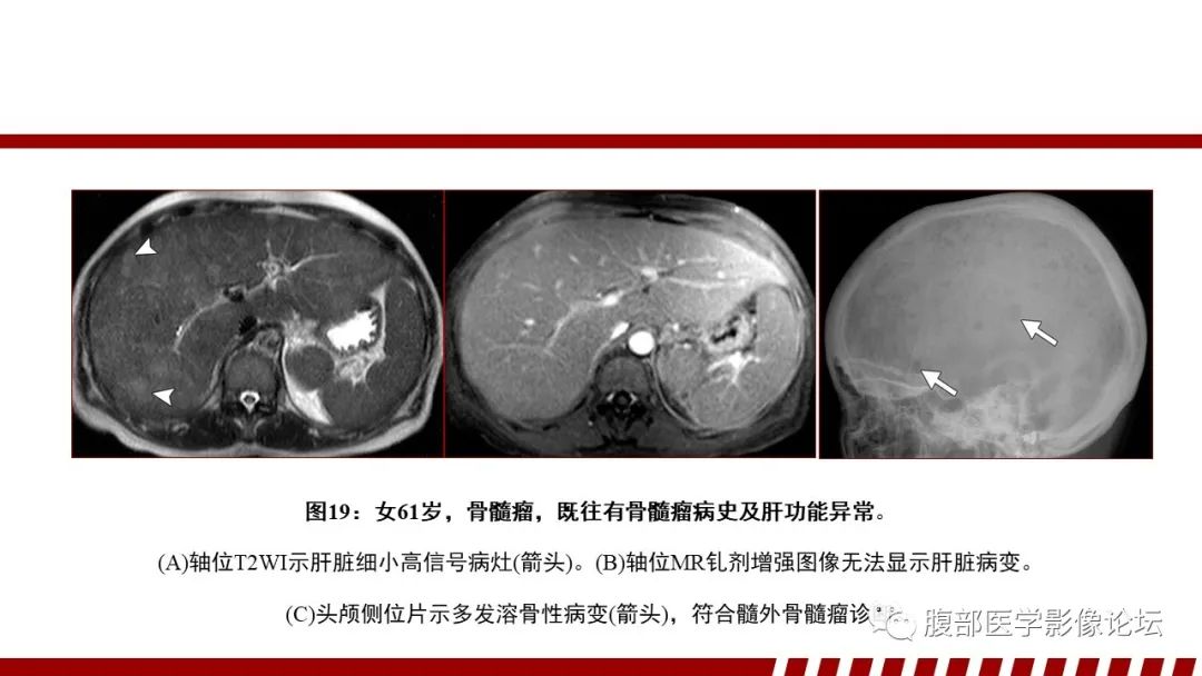 影像PPT - 【PPT】肝脏血液系统疾病影像综述-76
